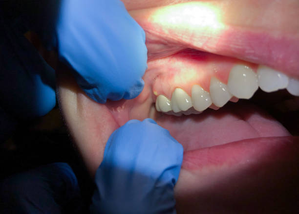 Best Emergency Care for Gum Disease in Lamar, CO